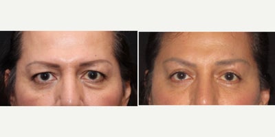 55-64 year old transgender woman treated with Eyelid Surgery, Forehead Reduction - Upper and lower blepharoplasty