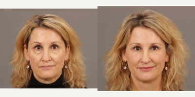 45-54 year old woman treated with Restylane Silk - Treatment of lower eyelid bags with Restylane Silk