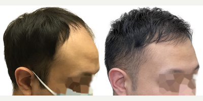 29 year old man treated with FUE Hair Transplant, Minoxidil and Finasteride - This is a gentleman who came to us at only age 29 for a hair transplant. His hair loss began in his early 20s and in only a few short years progressed to at least a Norwood Stage 5, or maybe beyond. He had never tried any evidence-based treatments to slow or reverse his hair loss. Despite his young age, he had complete obliteration of his hairline and front scalp, with near complete loss in the midscalp through to the crown. The result was disproportionate features, the loss of the frame to his face, and the appearance of being much older than his 29 years. Fortunately, he had an excellent donor area. Prior to surgery, we discussed the importance of supplementary non-surgical therapies like finasteride and minoxidil to help him preserve the hair he still had. In this way, we could use a hair transplant to replace what hes lost, knowing that hed be highly unlikely to lose additional hair in other areas. As a result of his large and dense donor area, we were able to perform a 3146 graft FUE surgery. This is one of the largest single session FUE surgeries ever performed at Toronto Hair Transplant Centre and is a larger graft amount for this type of surgery than average. You can see from our surgical drawings that his goal was not to achieve an overly aggressive hairline, but rather to have a natural hairline that preserved enough donor grafts to add some density in the midscalp and crown, while still giving him a frame to his face and good coverage upfront. He wanted the kind of hairline that would continue to look natural into his 30s, 40s, 50s and beyond. The majority of the grafts were distributed to the frontal scalp to rebuild the density there, while a few were added to the midscalp and crown. We knew this would not add overly thick density to those areas, but it would still make a significant difference. This patient returned to see us 13 months after his surgery. His results are absolutely amazing! He looks like, well, just a guy with hair! His forehead is much less prominent and he looks much more youthful and in line with his age. You can see in the detailed photo of his hairline that it looks completely natural and no one could ever tell hes had a hair transplant. His donor area continues to look dense without any noticeable evidence of even a large FUE harvest. He continues to use finasteride and minoxidil regularly, without any problems, and hasnt lost any additional hair. He looks great!