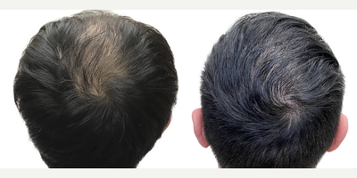 29 year old man treated with FUE Hair Transplant, Minoxidil and Finasteride - This is a gentleman who came to us at only age 29 for a hair transplant. His hair loss began in his early 20s and in only a few short years progressed to at least a Norwood Stage 5, or maybe beyond. He had never tried any evidence-based treatments to slow or reverse his hair loss. Despite his young age, he had complete obliteration of his hairline and front scalp, with near complete loss in the midscalp through to the crown. The result was disproportionate features, the loss of the frame to his face, and the appearance of being much older than his 29 years. Fortunately, he had an excellent donor area. Prior to surgery, we discussed the importance of supplementary non-surgical therapies like finasteride and minoxidil to help him preserve the hair he still had. In this way, we could use a hair transplant to replace what hes lost, knowing that hed be highly unlikely to lose additional hair in other areas. As a result of his large and dense donor area, we were able to perform a 3146 graft FUE surgery. This is one of the largest single session FUE surgeries ever performed at Toronto Hair Transplant Centre and is a larger graft amount for this type of surgery than average. You can see from our surgical drawings that his goal was not to achieve an overly aggressive hairline, but rather to have a natural hairline that preserved enough donor grafts to add some density in the midscalp and crown, while still giving him a frame to his face and good coverage upfront. He wanted the kind of hairline that would continue to look natural into his 30s, 40s, 50s and beyond. The majority of the grafts were distributed to the frontal scalp to rebuild the density there, while a few were added to the midscalp and crown. We knew this would not add overly thick density to those areas, but it would still make a significant difference. This patient returned to see us 13 months after his surgery. His results are absolutely amazing! He looks like, well, just a guy with hair! His forehead is much less prominent and he looks much more youthful and in line with his age. You can see in the detailed photo of his hairline that it looks completely natural and no one could ever tell hes had a hair transplant. His donor area continues to look dense without any noticeable evidence of even a large FUE harvest. He continues to use finasteride and minoxidil regularly, without any problems, and hasnt lost any additional hair. He looks great!