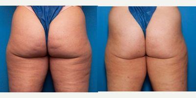 36 year old woman treated with Aveli - treatment of dimples on buttocks and lines on thighs