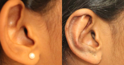 17 or under year old woman treated with Ear Surgery - Otoplasty