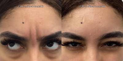 35-44 year old woman treated with Jeuveau - 3 days after Jeuveau for frown lines