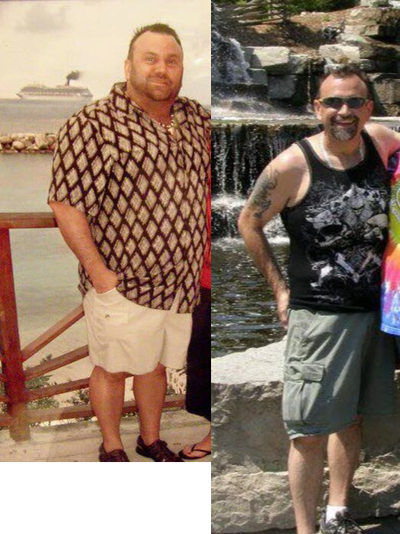 35-44 year old man treated with Lap Band - This patient fully changed his life style, now he is a marathoner runner.