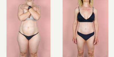35-44 year old woman treated with Mommy Makeover, Tummy Tuck, Breast Augmentation, Liposuction, Breast Implants - This lovely patient is shown 3 months post-op from mommy makeover consisting of a breast augmentation, abdominoplasty and liposuction. She came to me after hitting a plateau along her journey to a slimmer physique. Oftentimes, diet and exercise are not enough and surgery is needed to tighten muscles and remove excess skin. Her implants were smooth, round silicone and they were placed in a dual-plane to allow a small amount of lift. Here, you can see a huge transformation. Her results are exceptional because she adopted a healthy lifestyle after surgery to continue to improve upon her results.