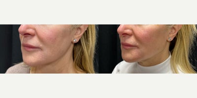 55-64 year old woman treated with Restylane Lyft, Restylane Contour, Restylane, Nonsurgical Neck Lift, Nonsurgical Facelift, Liq - Our wonderful client treated with 5 Syringes of Restalyne using the YLift technique. This technique will create a snatched jawline to help mimic the angle your jawline when you were younger.