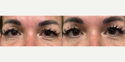 35-44 year old woman treated with Upneeq - Upneeq Treatment done on eyes