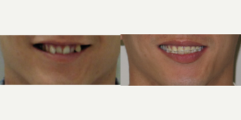 25-34 year old man treated with Damon Braces - Smile progress picture for patient using Damon System