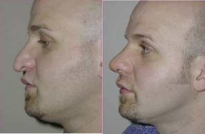Woman treated with Rhinoplasty - Woman treated with Rhinoplasty.