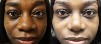 Rhinoplasty - There's nothing quite like a rhinoplasty to provide the subtle change you may be looking for. This patient is almost 3 months post procedure and couldn't be happier with her results!