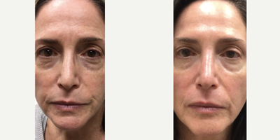 45-54 year old woman treated with ThermiSmooth - After only one treatment of ThermiSmooth around both eyes and around the mouth