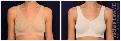 25-34 year old woman treated with Mentor Breast Implants - Breast augmentation. Follow-up photos taken 3 months after the procedure.