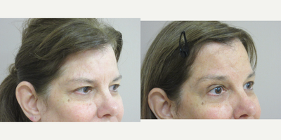 Forehead Lift - Patient is 62 years old and wanted to look awake and refreshed for a special event coming up.  Dr. Eric Schaffer recommended a Browlift procedure to lift her eyelids and open up her beautiful eyes.
