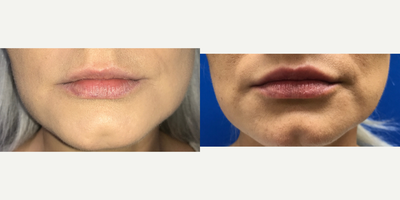 35-44 year old woman treated with Injectable Fillers - Restylane Silk filler injections in this young woman's upper and lower lips.