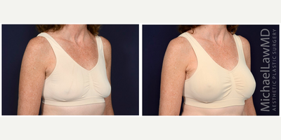 55-64 year old woman treated with Natrelle Breast Implants - Breast augmentation. Follow-up photos taken 1 month after the procedure.