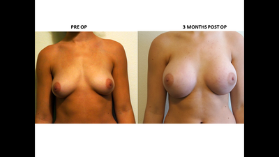 Uneven Creases After Breast Augmentation 92