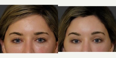 25-34 year old woman treated with Brow Lift - This young woman underwent a rotational endoscopic brow lift