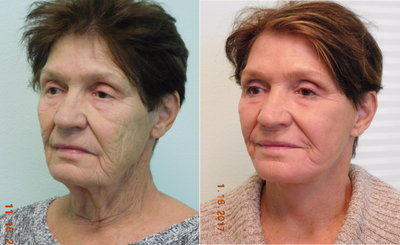 76 year old woman treated with Fractional CO2 Laser and Lower Facelift/Necklift - This woman presented to our Center with the concerns of severe sundamaged skin along with a drooping jawline and neck (with banding). Under local anesthesia with mild oral sedation (valium) we performed a lower facelift and necklift with a full face fractional CO2 laser treatment safely and comfortably in our Center. Her results demonstrate significant improvement in the shape and contour of her lower face and neck with noticeable improvement in her overall skin texture, tone, lines, and wrinkles. Her recovery time was approximately 10 days.