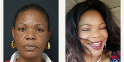 35-44 year old woman treated with Facelift - Facelift surgery - 10 days post-operative