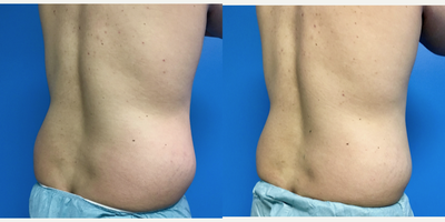 35-44 year old man treated with CoolSculpting - Treated bilateral flanks, pictures taken at 1 month post treatment