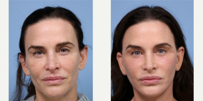 55-64 year old woman treated with Facelift Revision - This gorgeous patient came to us for a revision face and neck lift. She had a lift with a different surgeon a few years back and was unsettled with the final result. Drs. L&P gave her the refreshed appearance she had been dreaming of. This patient was beautiful beforehand, but she still had some concerns with skin tightening. It has been a true pleasure to have this patient in our care and we are thrilled every time her vibrant energy is around the office.