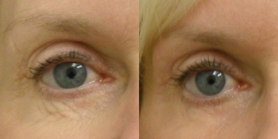 55-64 year old woman treated with Pixel CO2 Laser - Patient had 2 treatments under her eyes