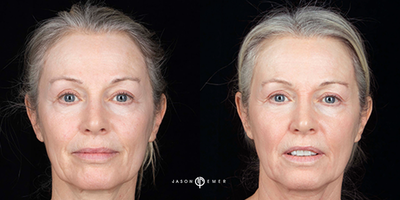 45-54 year old woman treated with Cosmelan - Female patient with Cosmelan treatment