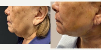 75 and up year old woman treated with Laser Liposuction, Renuvion, Nonsurgical Neck Lift - This client was treated using Power Assisted Liposuction, Renuvion Skin Tightening, along with a Platysmalplasty and suture suspension. This is a minimally invasive neck lift.