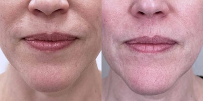 45-54 year old woman treated with Ellacor - A 50-year-old female received Ellacor treatment targeting the lower face to reduce fine lines and improve skin laxity. The procedure resulted in smoother, firmer skin with enhanced jawline definition, delivering a refreshed and youthful appearance while maintaining natural facial harmony.