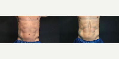 Man treated with CoolTone - Man treated with CoolTone