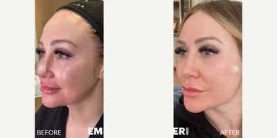 Woman treated with Moxi - Woman treated with Moxi