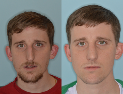 Male Rhinoplasty for the Tension Nose - The doctor discusses his techniques for the male patient with what is known as a tension nose deformity. In this case, the patient was seeking to reduce the over-projection of the bridge of the nose and to raise the droopiness of the tip. You will note he also had difficulty breathing through the nose as is evident from his mouth opening and mouth-breathing in the pre-operative photos and his closing of the mouth given his improvement in breathing through the nose after surgery.