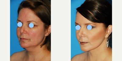 55-64 year old woman treated with Facelift, Rhinoplasty, Chin Liposuction - Women treated with Facelift, Rhinoplasty and Chin liposuction