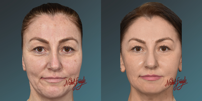 35-44 year old woman treated with Fraxel Laser - 35-44 year old woman treated with Fraxel Laser
