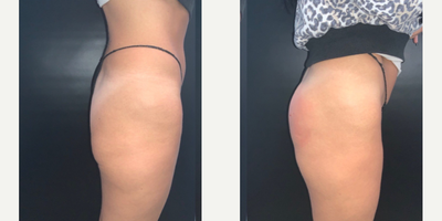 45-54 year old woman treated with Sculptra Aesthetic, Nonsurgical Butt Lift - Sculptra BBL by Dr Rosy Sandhu