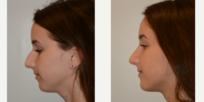 18-24 year old woman treated with Rhinoplasty - Rhinoplasty - Dorsal Hump
