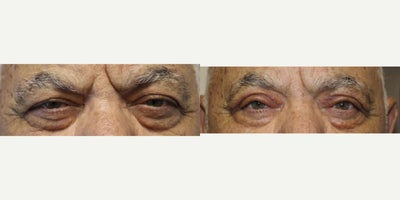 65-74 year old man treated with Ptosis Surgery - Ptosis Repair - (Post-Operative Week 1)