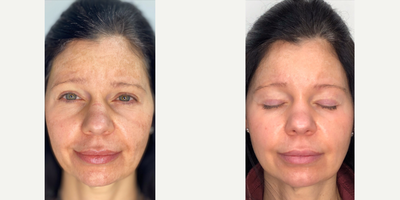 35-44 year old woman treated with Lumecca, IPL - IPL Facial done with Lumecca
