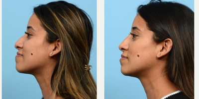 25-34 year old woman treated with Nonsurgical Nose Job, Dermal Fillers - Dr. Wise performed a non-surgical rhinoplasty on this patient to smooth the bridge of her nose and to subtly lift the tip.