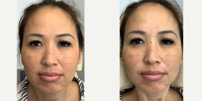 45-54 year old woman treated with Contour Thread Lift - 45 year old female - received PDO Threads in lower face. Combination of short threads + long barbed threads to create a slimmer facial contour and smooth out nasolabial lines.
