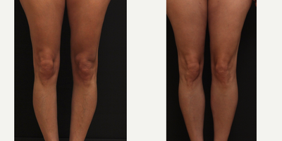 25-34 year old woman treated with Calf Implant - 25-34 year old woman treated with Calf Implant