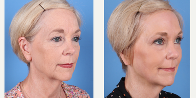 64 year old woman treated with Phenol Peel to full face - Dr.Sukkar performed a Phenol Peel to this 64 year old patient. Photos taken at 3 months post op.(281) 990-8487 | 14018 Aesthetic Circle Houston, TX 77062 | www.drsukkar.com