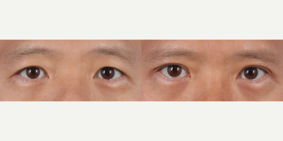 Man treated with Eyelid Surgery - Man treated with Eyelid Surgery