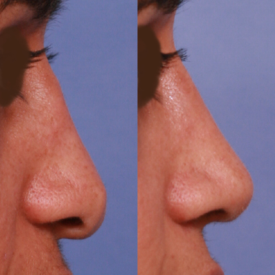 35-44 year old woman treated with Revision Rhinoplasty with hanging columela and downturned tip - Dr. Holden addressed this woman's concerns with a previous rhinoplasty. He rebuilt her nose to support the collapsed tip and refine the shape.