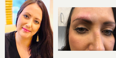 25-34 year old woman treated with Bellafill - Bellafill was used on our patient to treat a scar and smooth out the scar demarcation.