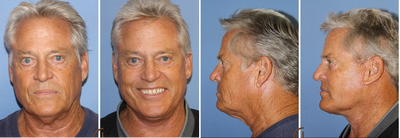 Male Lower Facelift and Neck Lift - Local Anesthesia and Twilight Sedation - No General Anesthesia - Male lower face and neck lift performed by surgeon Dr. Kevin Sadati. For men it is important to find a cosmetic surgeon that understands how to maintain a man's masculine features in their facelift results. Dr. Kevin Sadati is able to use his specialized facelift technique to obtain very natural-looking results for his male and females patients. He performs his lower face and neck lifts utilizing local anesthesia and twilight sedation.  No general anesthesia is needed for a comfortable experience. This patient is only 2 months post surgery and looks amazing.