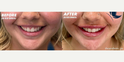 Woman treated with Lip Fillers, Restylane Kysse - Woman treated with Lip Fillers, Restylane Kysse