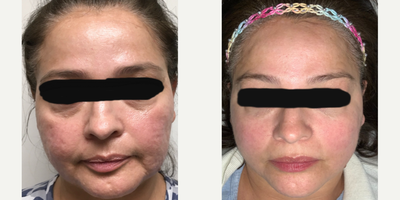 45-54 year old woman treated with Secret RF - Patient has had a total of 4 Secret RF treatments with PRP, as well as followed a skin regimen provided by us. She is more than thrilled with her results, and finally has the confidence she had been lacking due to her scars.