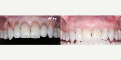 25-34 year old woman treated with Tooth Repair - Patients often suffer from a condition called gingival recession. What happens is that your gum line moves away from the enamel of the tooth, leaving expose the root surface of the tooth. Decay, sensitivity, pain, inflammation and tooth loss can results from not treating this condition. Gum grafting, minimally invasive technique, pinhole gum rejuvenation, no cutting, no stitches, minimal recovery time.
