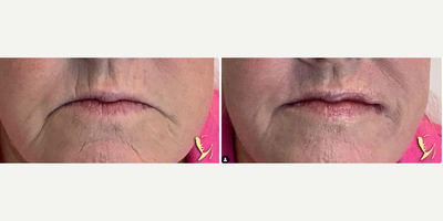 Woman treated with Restylane Kysse, Lip Fillers - Woman treated with Restylane Kysse, Lip Fillers